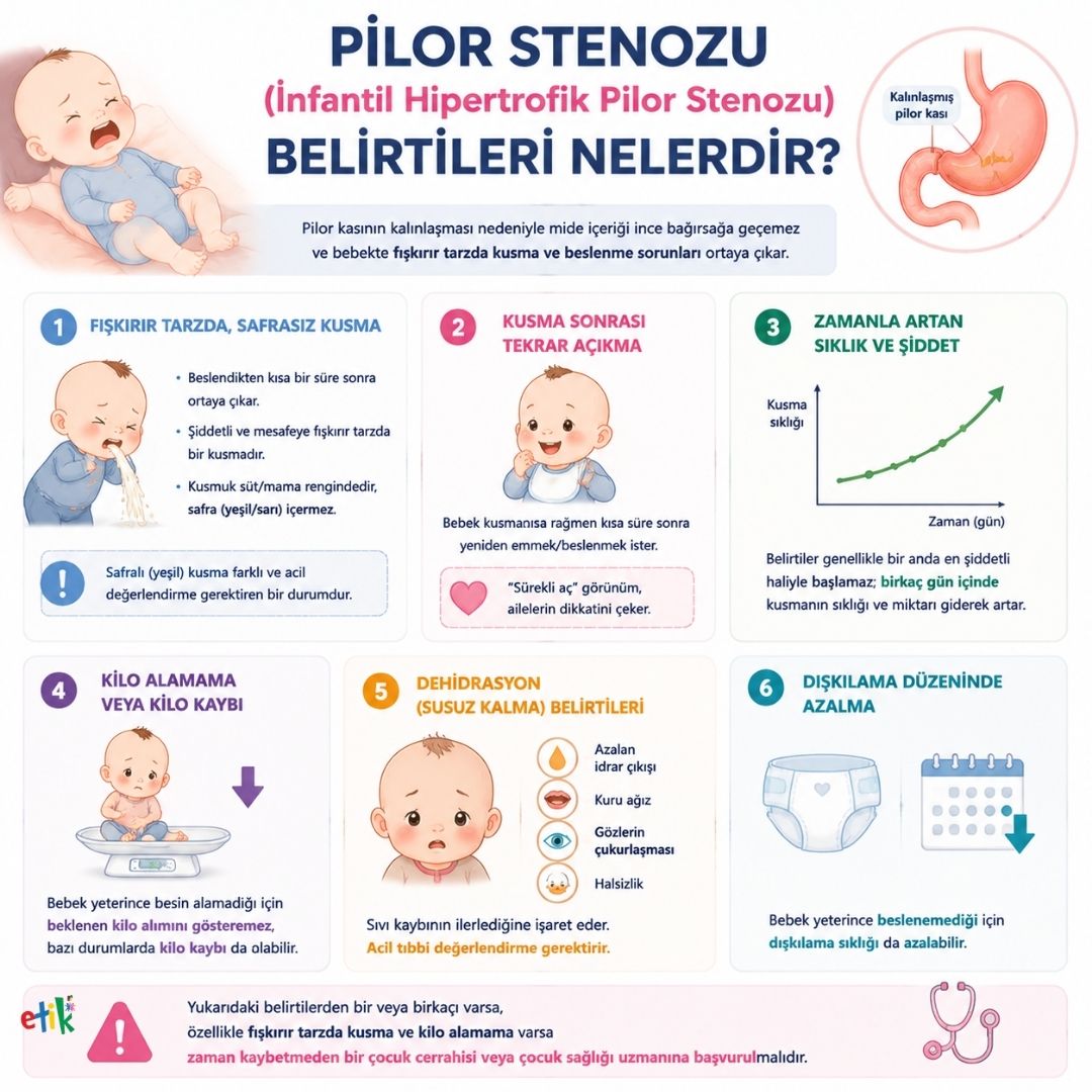 pilor stenozu belirtileri