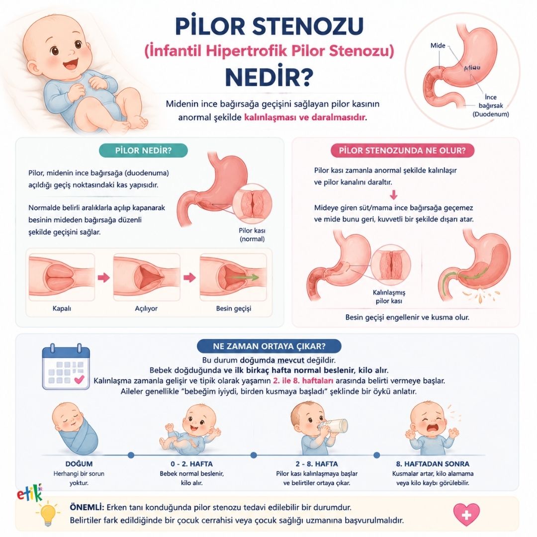 Bebeklerde pilor stenozu (infantil hipertrofik pilor stenozu) nedir